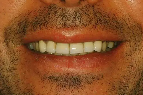 Close up of man smiling with slightly uneven teeth