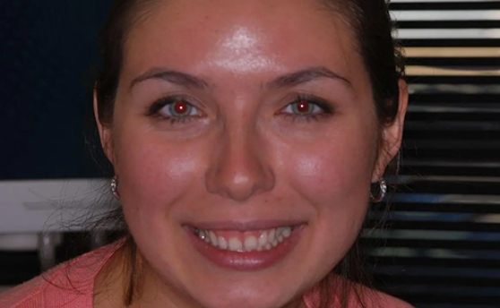 Smiling brunette woman with uneven gumline