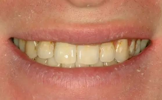 Man smiling with discolored and damaged teeth before veneers