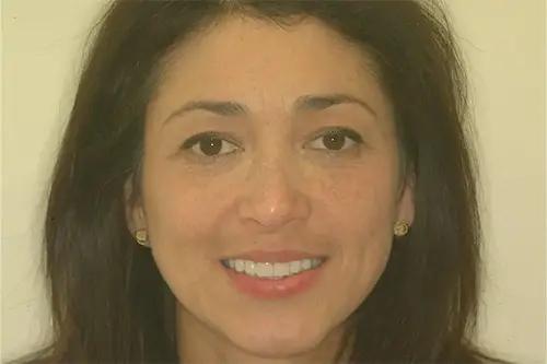 Woman with dark hair smiling after fixing her teeth with veneers