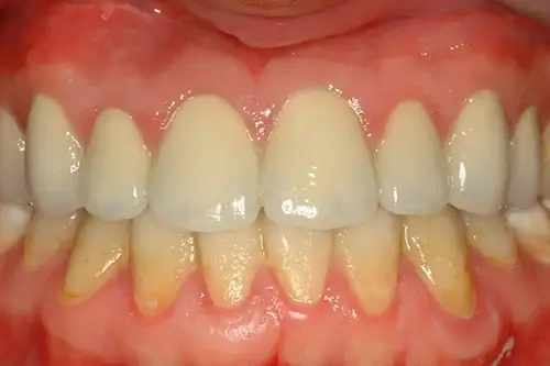 Mouth after correcting stained upper teeth with veneers