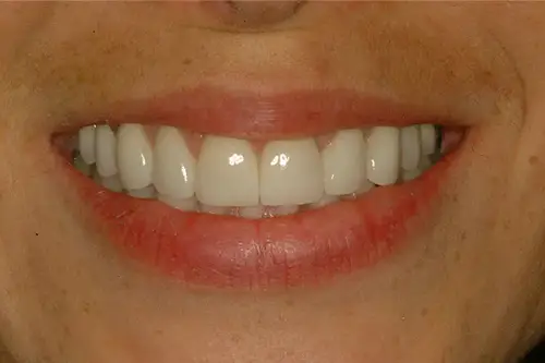 Mouth after covering slightly chipped and stained teeth with veneers