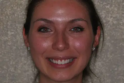 Smiling brunette woman with even gumline