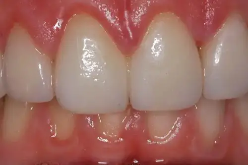 Close up of brighter teeth with no stains