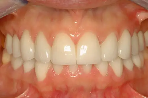 Mouth with whiter teeth and no chipped teeth