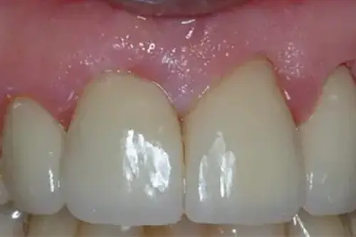 Close up of whiter and restored two front teeth