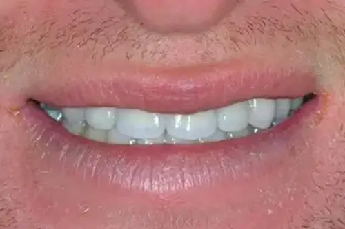 Man smiling after fixing discolored and damaged teeth with veneers