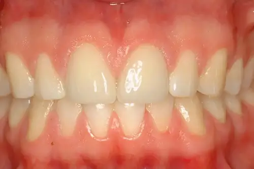 Mouth after treating chipped two front teeth with veneers