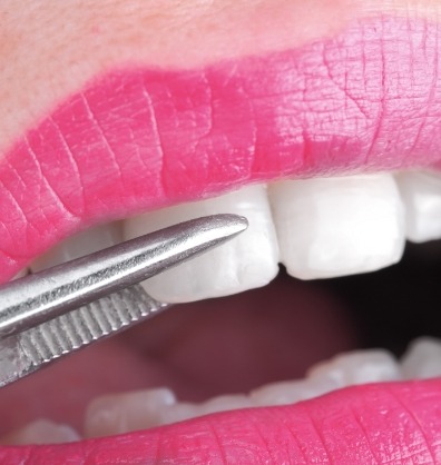 Close up of veneer being placed over a tooth